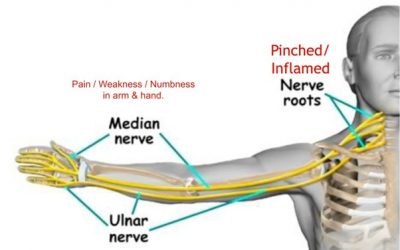 Relieving Nerve Pain in the Neck